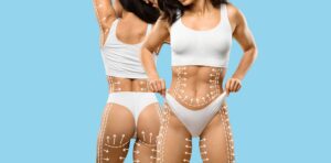 La lipoaspiration avant l’été : tout ce qu’il faut savoir